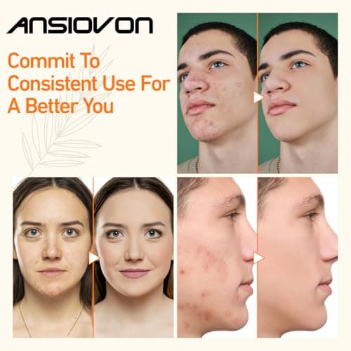 ANSIOVON Blue Light Therapy Wand thumbnail 4