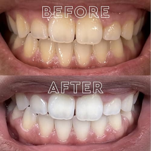 MOON Dissolving Teeth Whitening Strips thumbnail 4