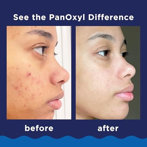 PanOxyl Acne Foaming Wash 10% Benzoyl Peroxide thumbnail 4