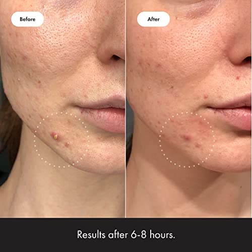 Mighty Patch Invisible+ by Hero Cosmetics (39 Count) thumbnail 4