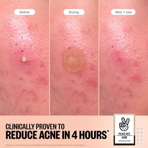 Peace Out Acne Healing Dots (20 Count) thumbnail 3