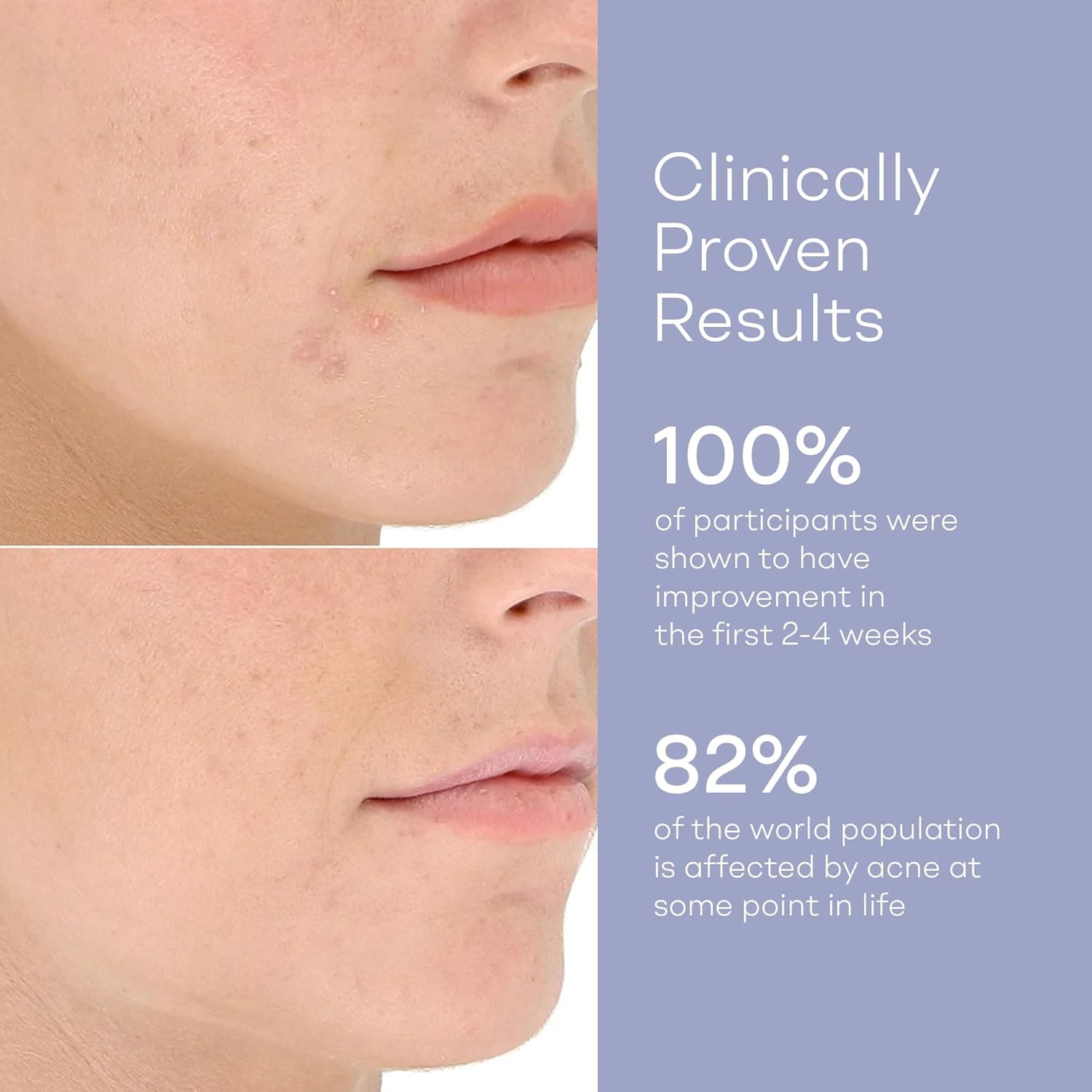 LightStim for Acne thumbnail 3